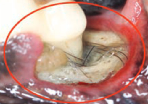 Willows-Periodontitis-1