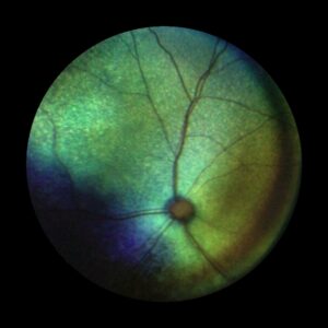 An eye image taken using a fundus camera